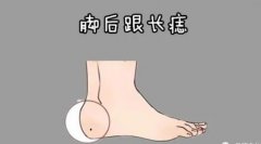 女人脚后跟有痣代表什么